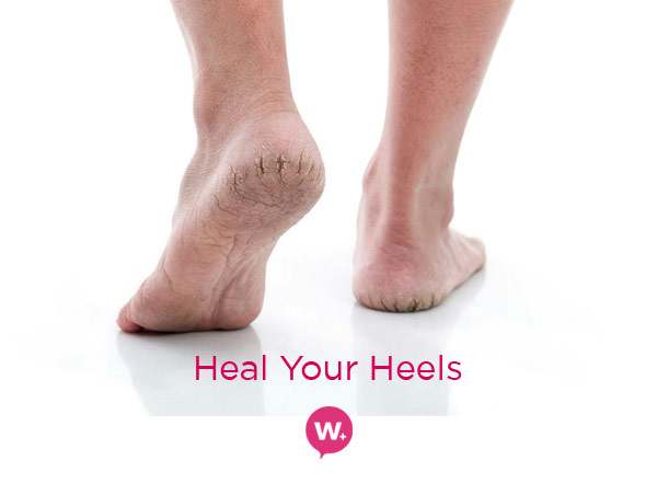 Seven natural ways to treat and prevent cracked heels | Health - Hindustan  Times